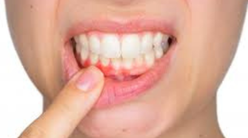 How Long Can You Keep Your Teeth With Periodontal Disease