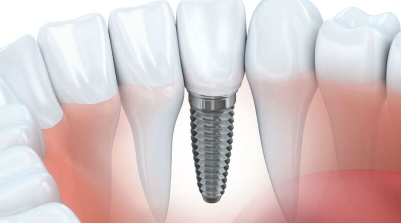 Why Are Dental Implants So Expensive?