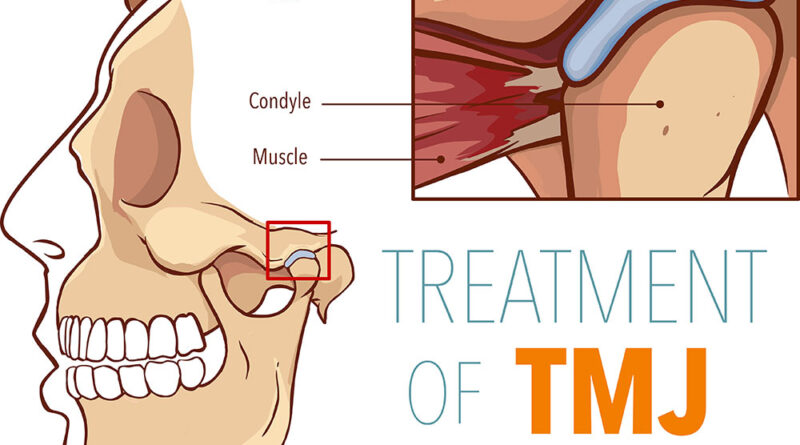 How Long Does TMJ last?