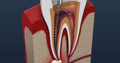 How Long Does a Root Canal Last?