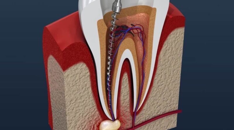 How Long Does a Root Canal Last?